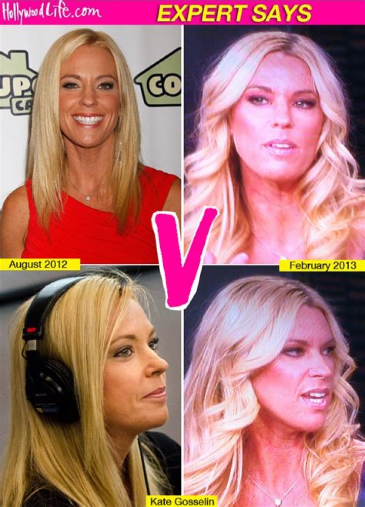 Kate Gosselin Plastic Surgery Proof — Facelift & Nose Job For Kate – Hollywood Life