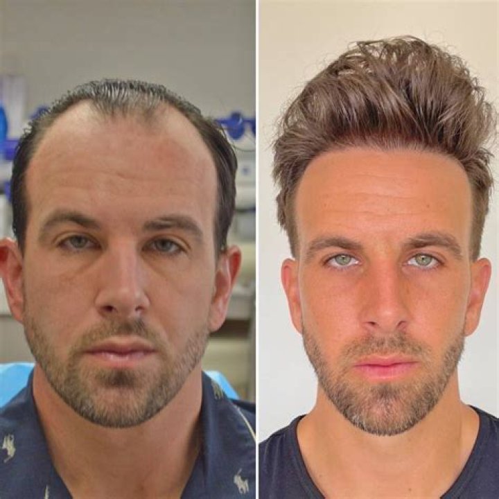 See Hair Transplant Makeover – Hollywood Life